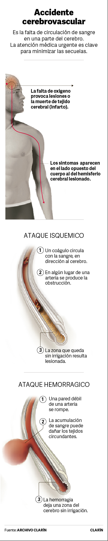 Accidente cerebrovascular - ACV