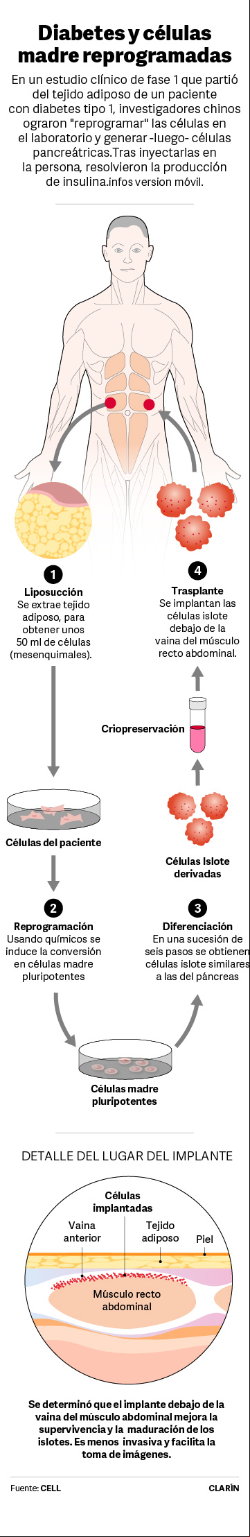 Implante de células islote reprogramadas desde células adiposas - diabetes tipo 1